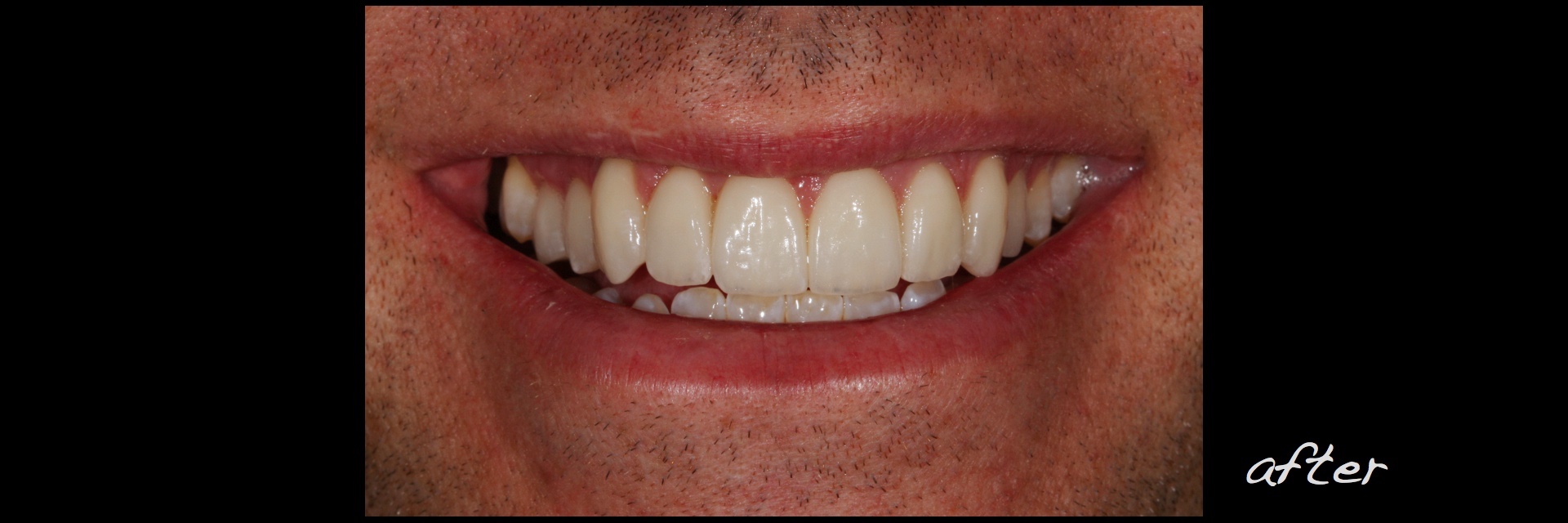 Case Study - Veneer Therapy