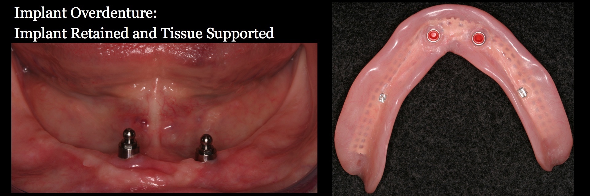 Case Study Overdenture Procedure