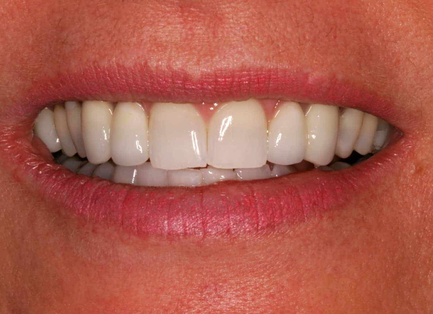 Case Study - Dental Bridges