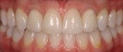 Partial Tooth Replacement Denver