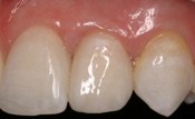 missing_incisors4