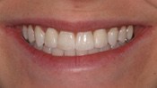 missing_incisors6