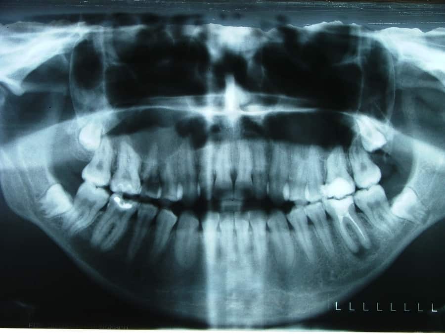 Medication-Related Osteonecrosis of the Jaw