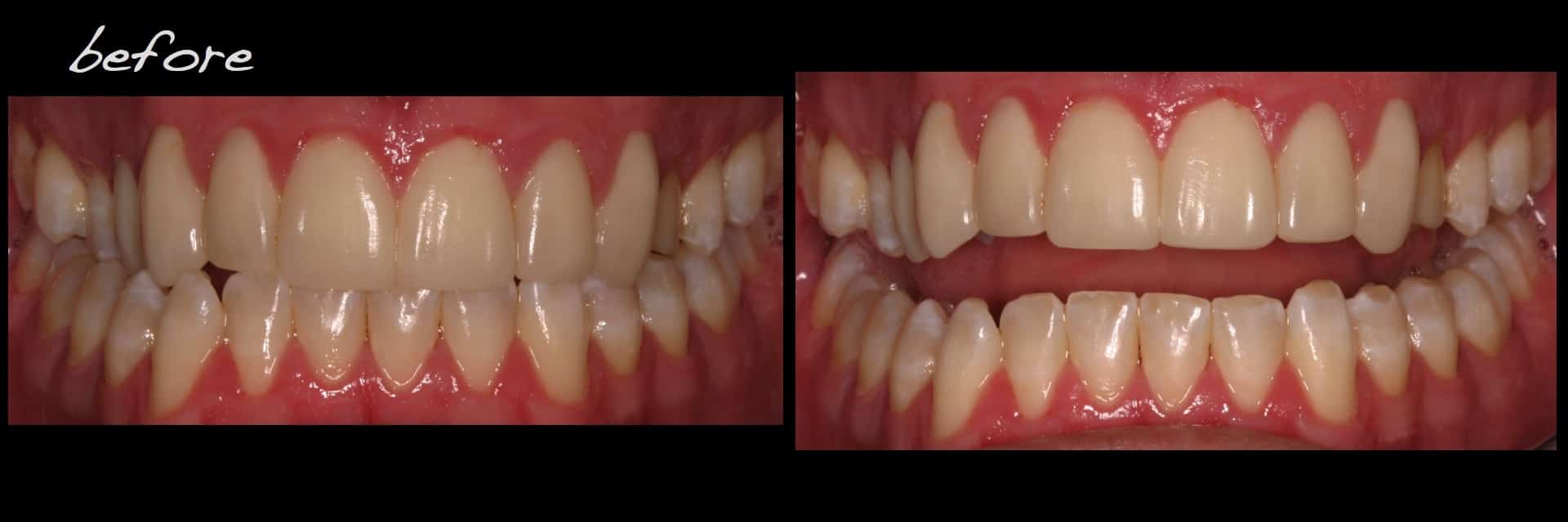 Revised porcelain laminate veneer therapy and associated preocclusal