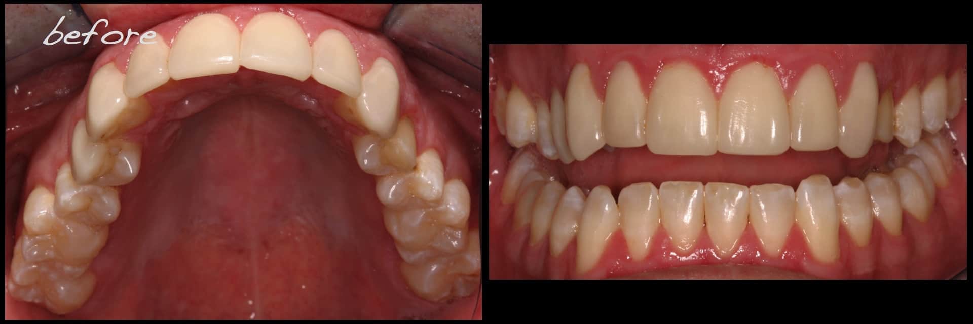 Revised porcelain laminate veneer therapy and associated preocclusal
