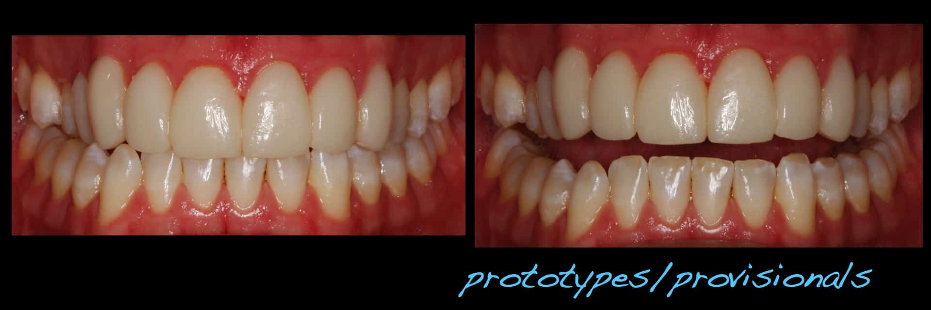 Revised porcelain laminate veneer therapy and associated preocclusal
