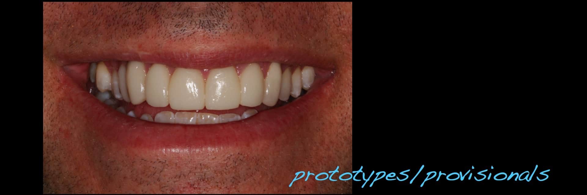 Revised porcelain laminate veneer therapy and associated preocclusal