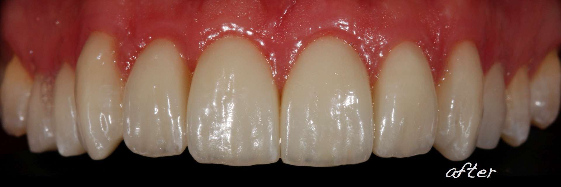 Revised porcelain laminate veneer therapy and associated preocclusal