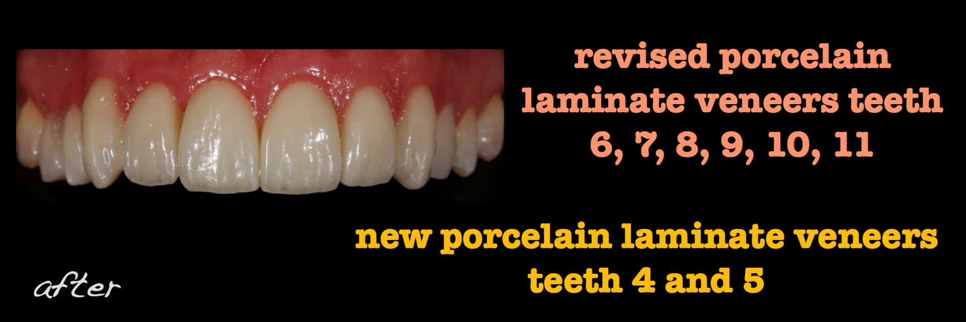 Revised porcelain laminate veneer therapy and associated preocclusal