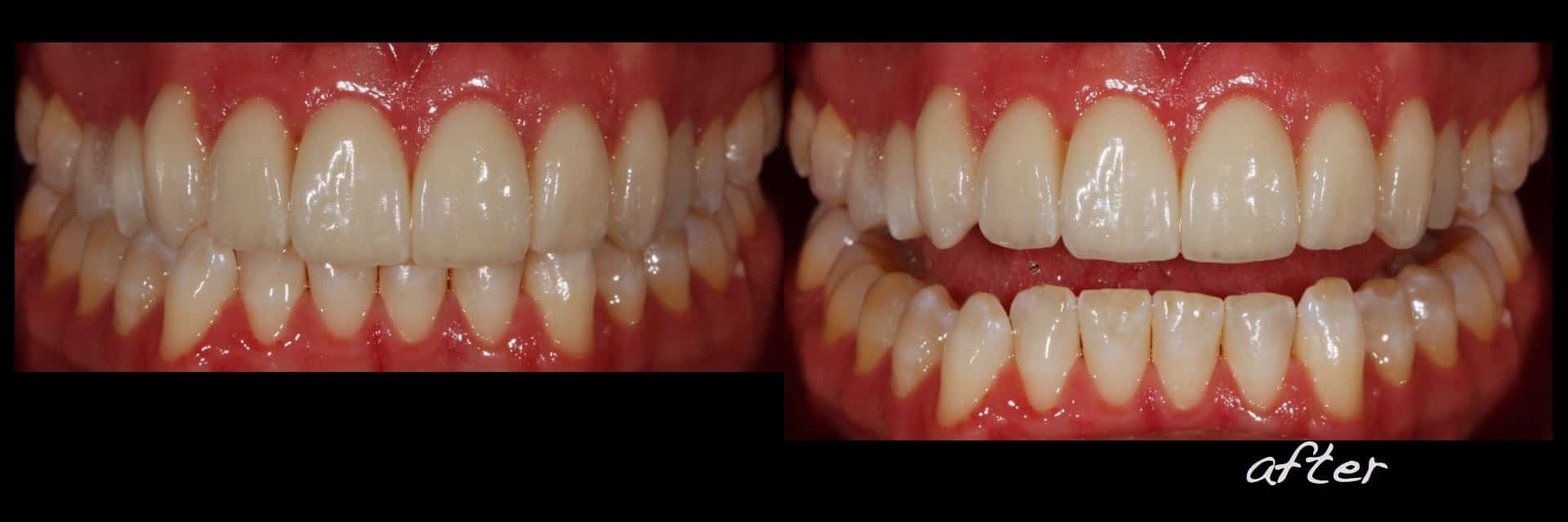 Revised porcelain laminate veneer therapy and associated preocclusal