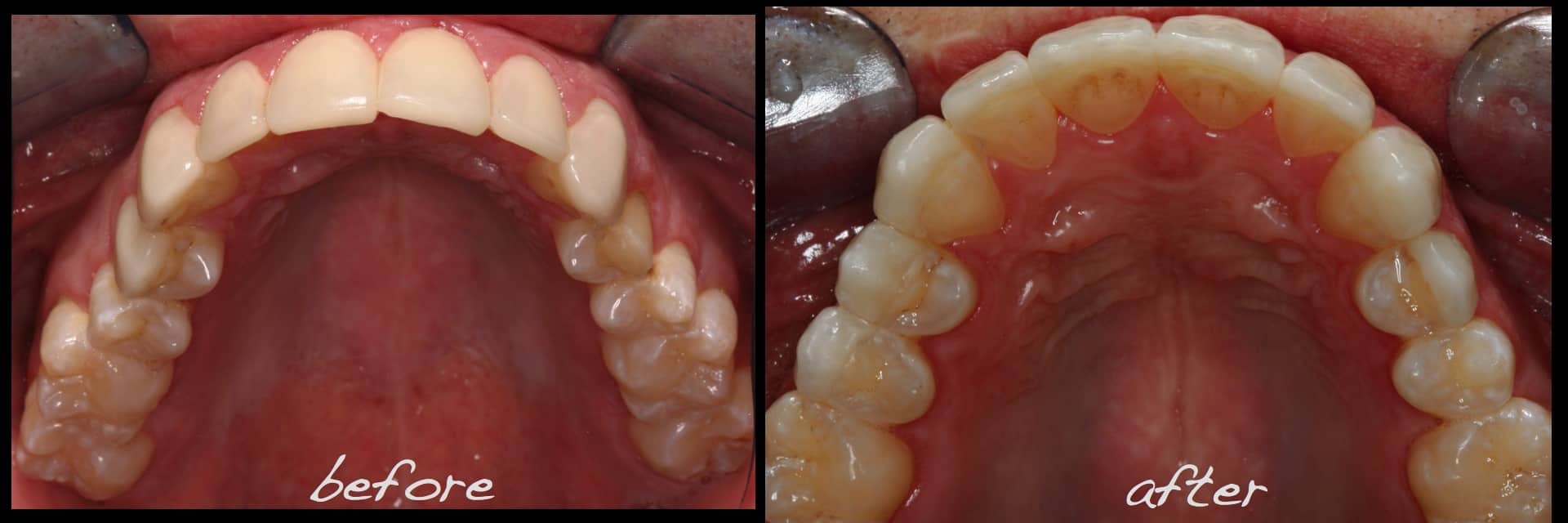 Revised porcelain laminate veneer therapy and associated preocclusal